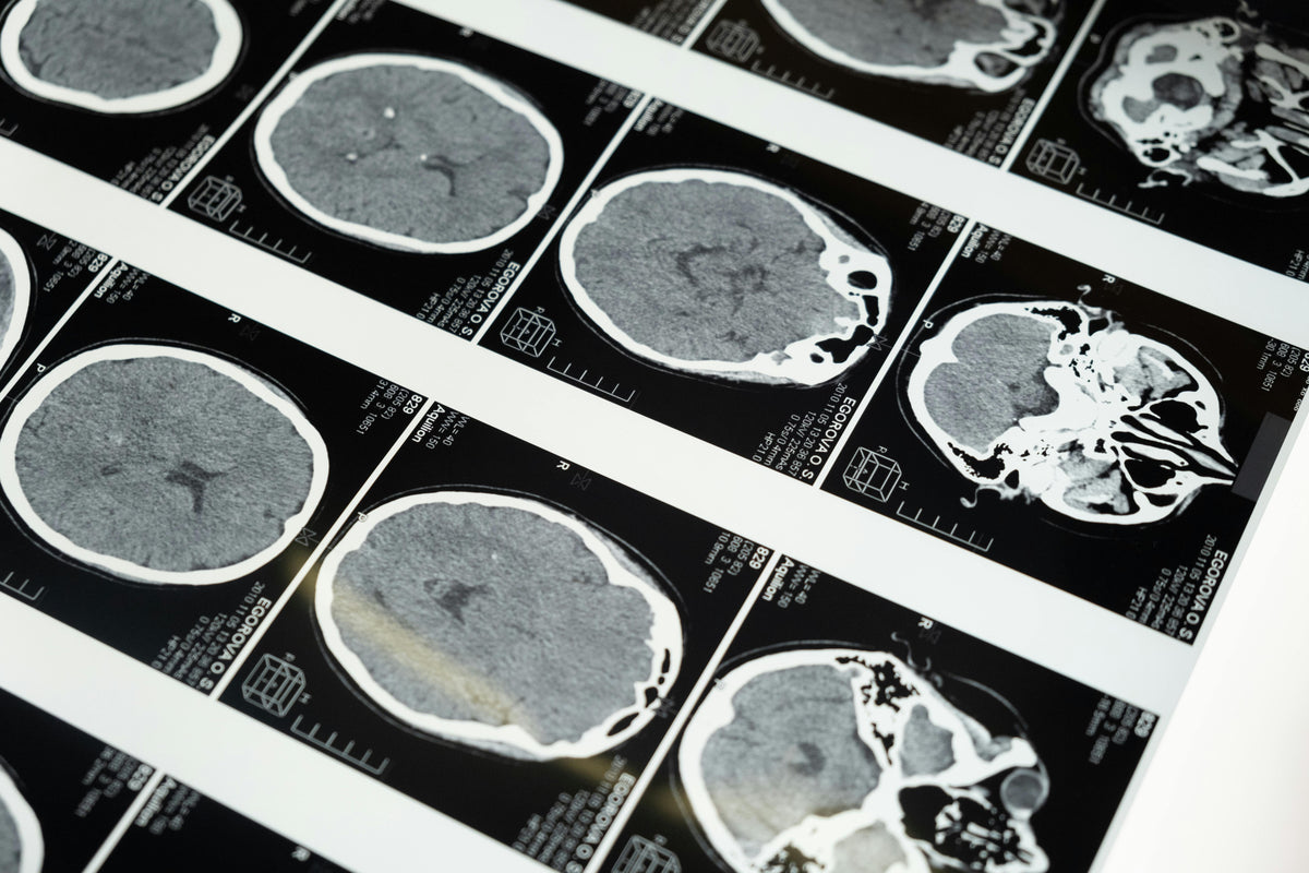 Cognizin Citicolin – Therapeutische Anwendungen und aktuelle Studienlage